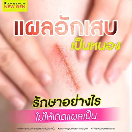 แผลอักเสบเป็นหนอง คืออะไร สาเหตุเกิดจาก กี่วันหาย วิธีดูแลรักษาอย่างไร