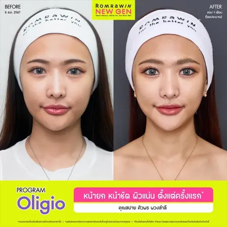 ภาพเปรียบเทียบก่อนหลังทำ Oligio ยกกระชับหน้า คุณสปาย
