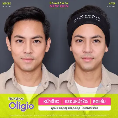 ภาพเปรียบเทียบก่อนหลังทำ Oligio หน้าเรียว กรอบหน้าชัด คุณพิช วิชญ์วิสิฐ