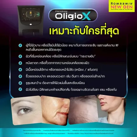 โปรแกรม Oligio X เหมาะกับใครบ้างในการยกกระชับผิว