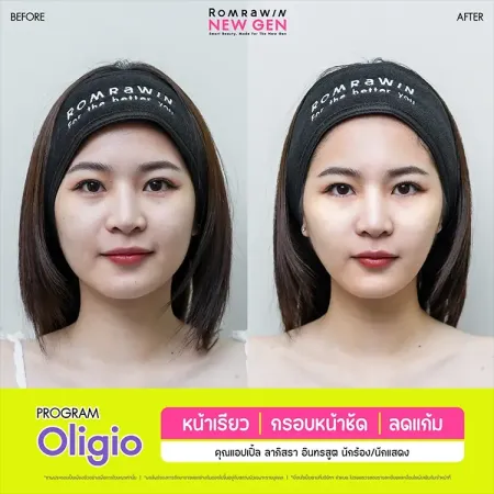 รีวิว PROGRAM Oligio หน้าเรียว กรอบหน้าชัด ลดแก้ม ภาพเคสรีวิวเปรียบเทียบก่อนทำและหลังทำยกกระชับใบหน้าของผู้หญิง