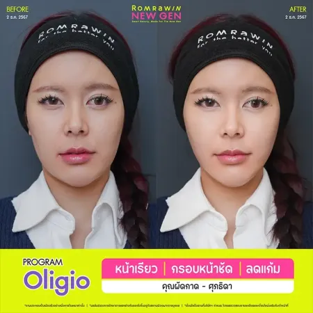 รีวิว PROGRAM Oligio หน้าเรียว กรอบหน้าชัด ลดแก้ม ภาพเคสรีวิวเปรียบเทียบก่อนทำและหลังทำปรับรูปหน้ายกกระชับแก้มของผู้หญิง