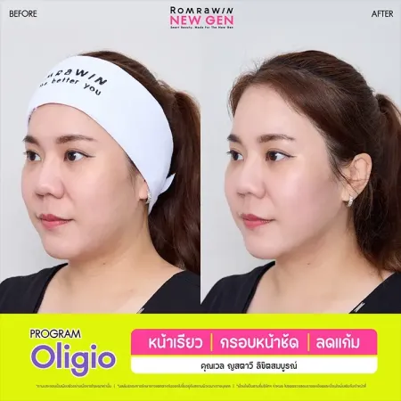 รีวิว PROGRAM Oligio หน้าเรียว กรอบหน้าชัด ลดแก้ม ภาพเคสรีวิวเปรียบเทียบก่อนทำและหลังทำมุมข้างแสดงความกระชับของแก้มผู้หญิง