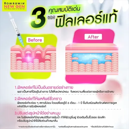 ฟิลเลอร์แท้
