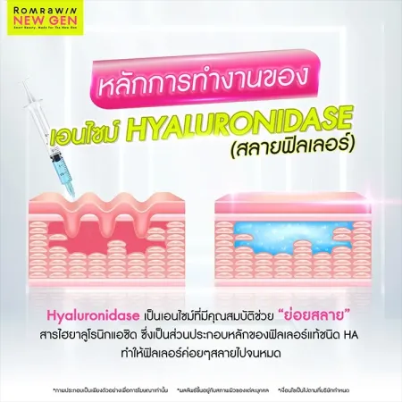 ฉีดสลายฟิลเลอร์