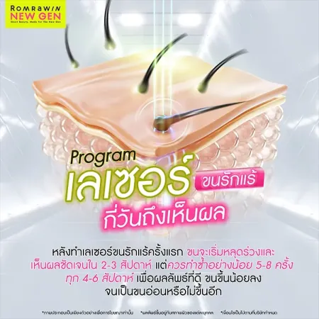 เลเซอร์ขนรักแร้