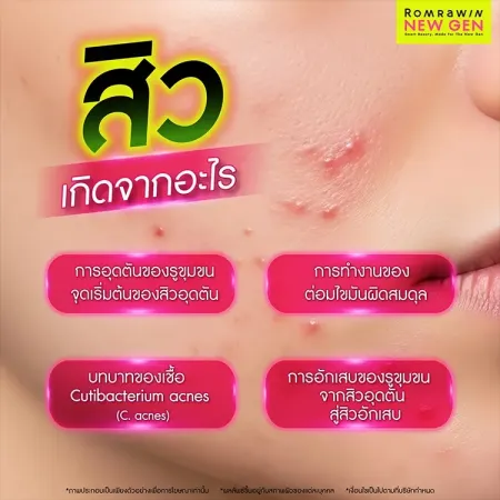 AC Clear เช็กสาเหตุสิวเกิดจากอะไร อินโฟกราฟิกอธิบายปัจจัยการอุดตันของรูขุมขนบนผิวหน้า