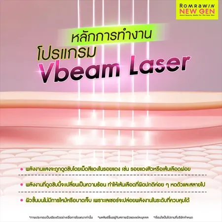 Vbeam Laser