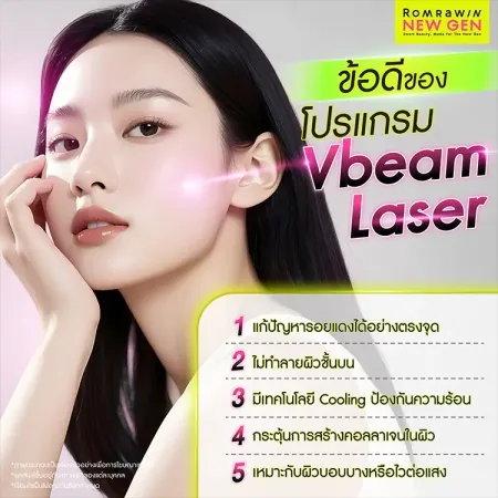 Vbeam Laser