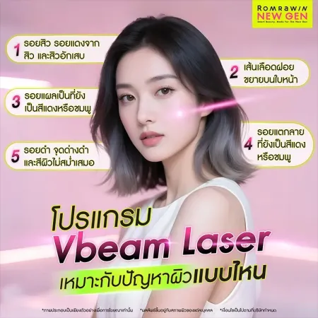 Vbeam Laser