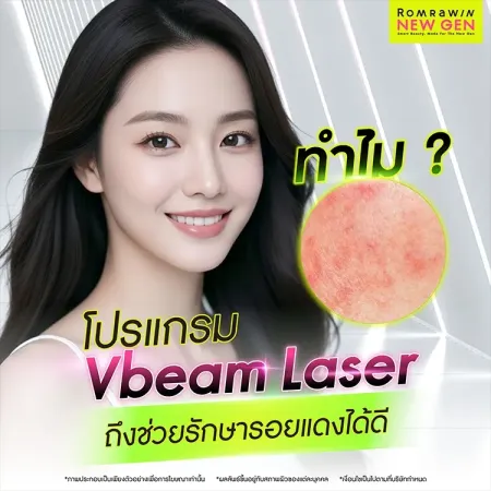 Vbeam Laser
