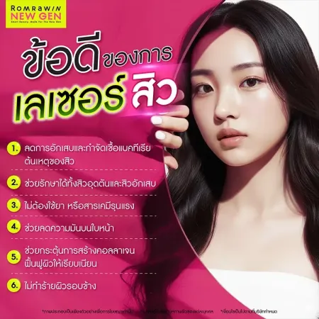 เลเซอร์สิว