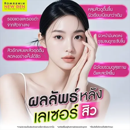 เลเซอร์สิว