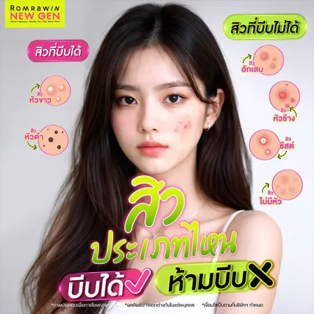บีบสิว