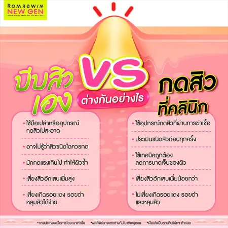 บีบสิว