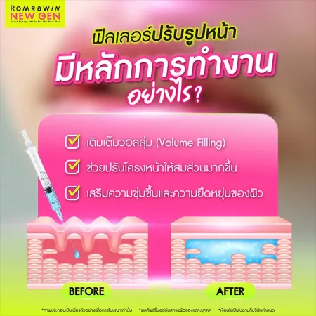 ฟิลเลอร์ปรับรูปหน้า