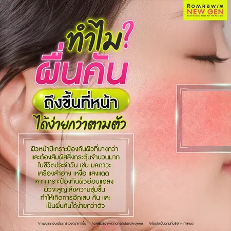 ผื่นคัน