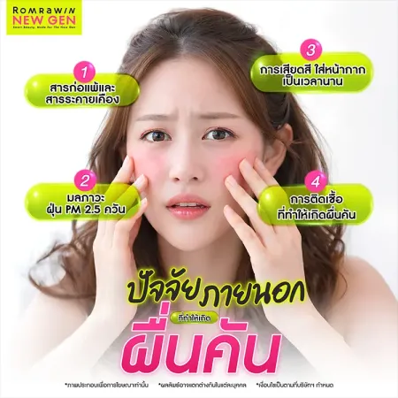 ผื่นคัน