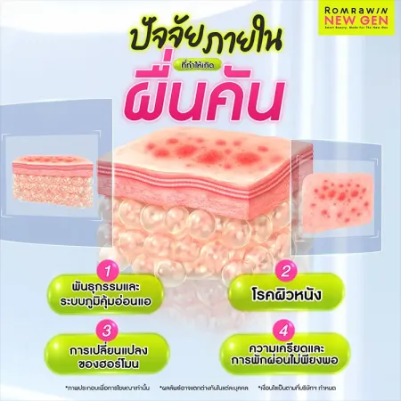 ผื่นคัน