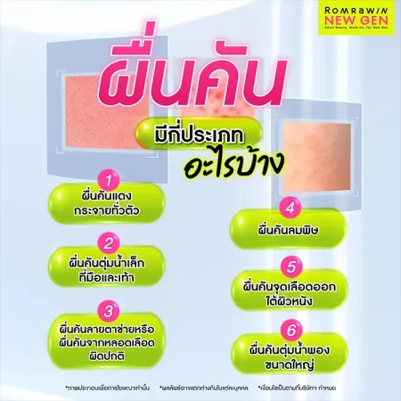 ผื่นคัน