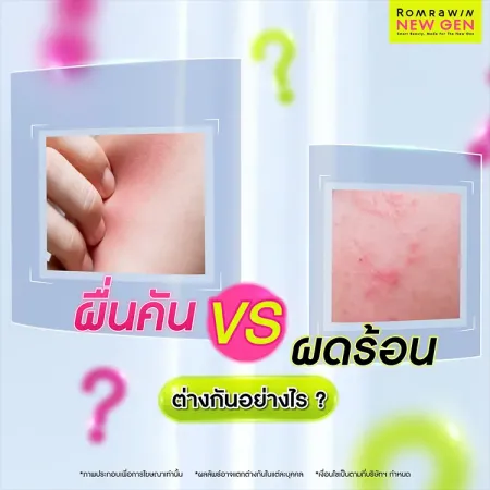 ผื่นคัน