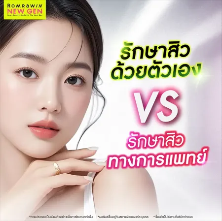 วิธีรักษาสิว
