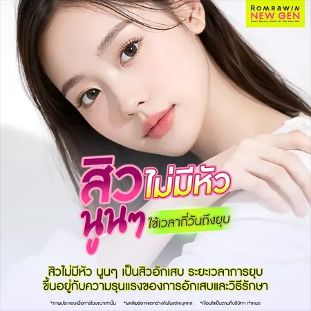 สิวไม่มีหัว นูนๆ ใช้เวลากี่วันถึงยุบ เช็กระดับความรุนแรงของวงจรสิวอักเสบไตแข็งระบมใต้ผิวหนังบนใบหน้า