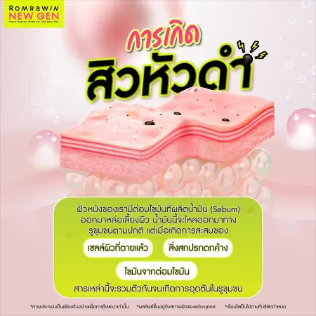 กลไกการเกิดสิวหัวดำ รูขุมขนอุดตันเกิดจากอะไร โดยแพทย์