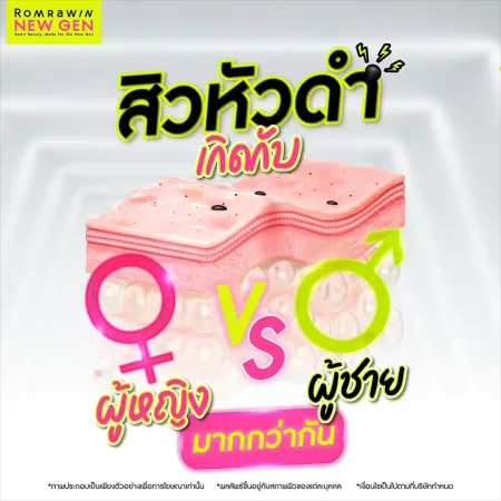 สิวหัวดำเกิดกับผู้ชายหรือผู้หญิงมากกว่ากัน ไขข้อสงสัยโดยแพทย์