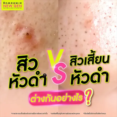 สิวหัวดำ VS สิวเสี้ยนหัวดำ ต่างกันอย่างไร พร้อมวิธีรักษาโดยแพทย์