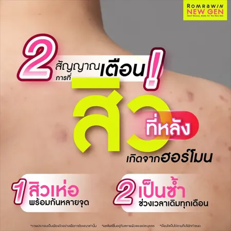 สิวที่หลังเกิดจาก