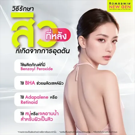 สิวที่หลังเกิดจาก