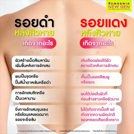 สิวที่หลังเกิดจาก