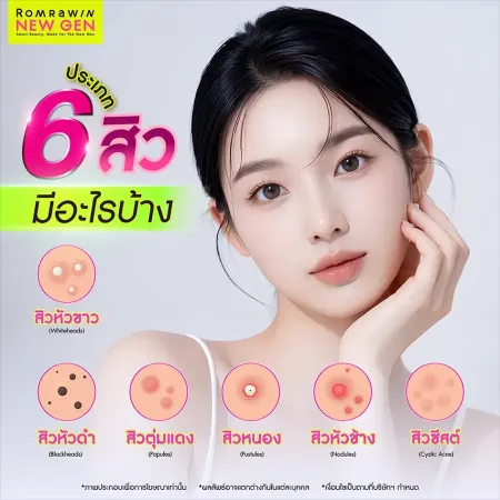ประเภทสิว