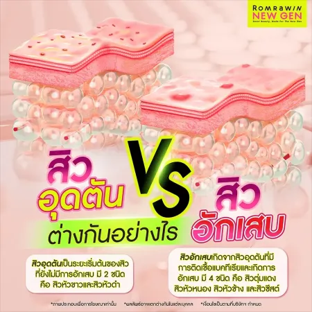 ประเภทสิว