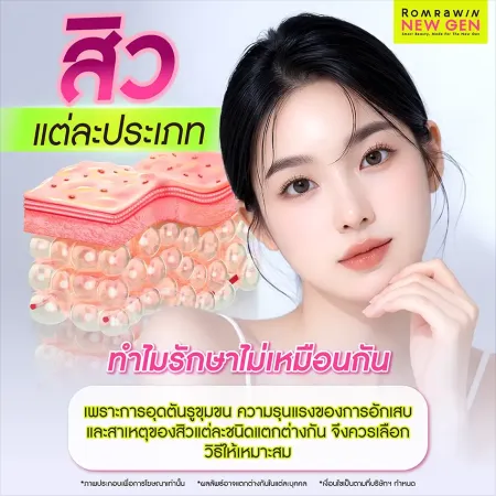 ประเภทสิว