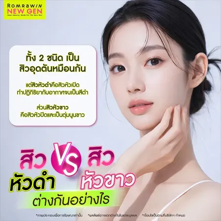 ประเภทสิว