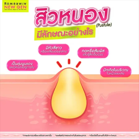 สิวหนอง