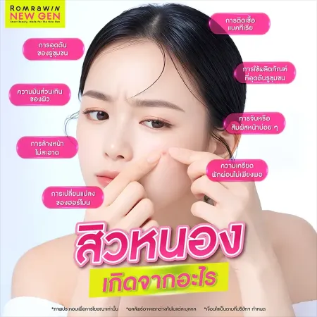 สิวหนอง