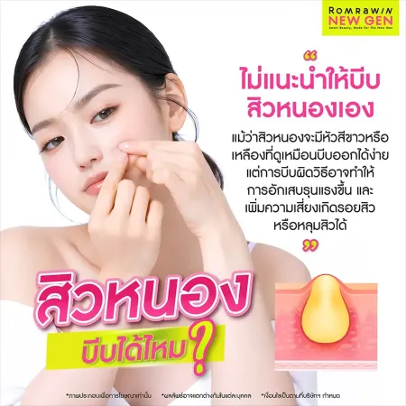สิวหนอง