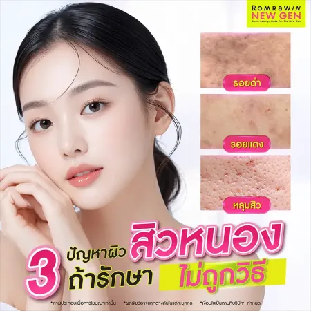 สิวหนอง
