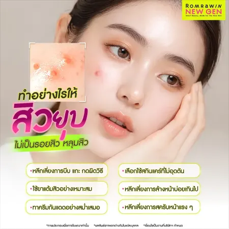 ทำอย่างไรให้สิวยุบ ไม่เป็นรอยสิว หลุมสิว ส่องเช็กลิสต์วิธีดูแลโครงสร้างผิวหน้าอย่างถูกวิธีหลังเผชิญปัญหาสิวอักเสบ