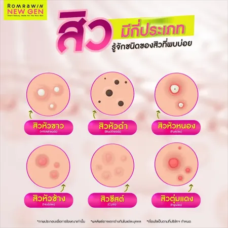 สิวมีกี่ประเภท