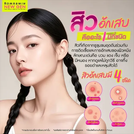 สิวมีกี่ประเภท