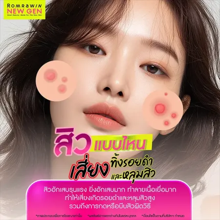 สิวมีกี่ประเภท