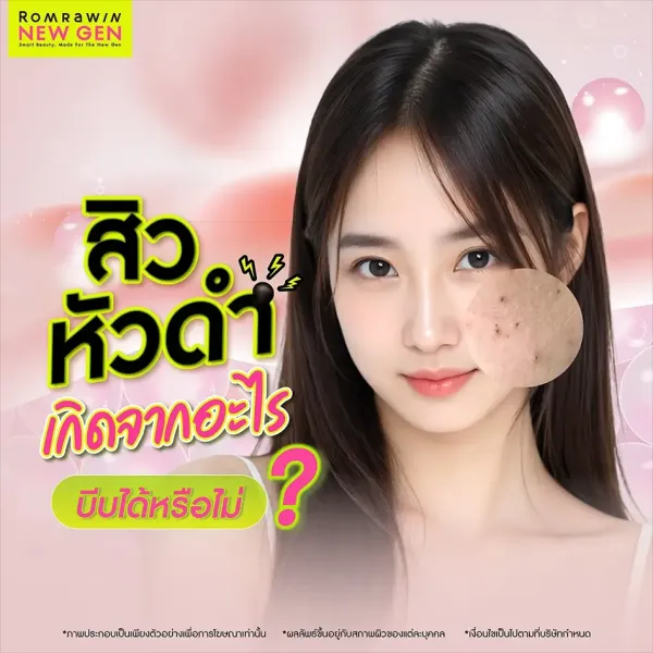 สิวหัวดำเกิดจากอะไร? รู้ทันสาเหตุและวิธีรักษาสิวเร่งด่วน