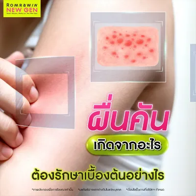 ผื่นคัน สาเหตุเกิดจากอะไร? มีกี่ประเภท มีวิธีป้องกันอาการอย่างไร