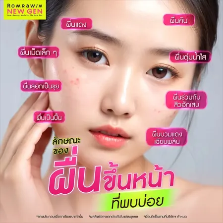 ผื่นขึ้นหน้า