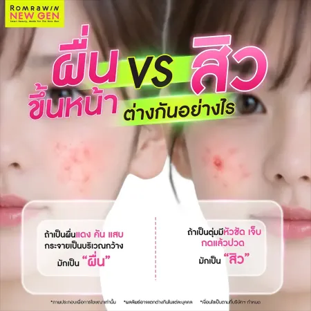 ผื่นขึ้นหน้า