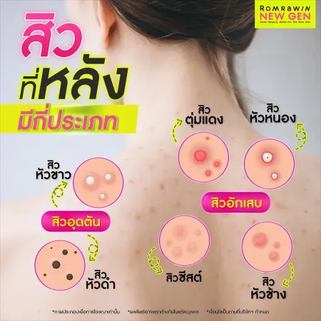 สิวที่หลัง